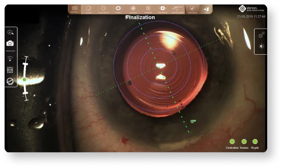 Alcon Verion System