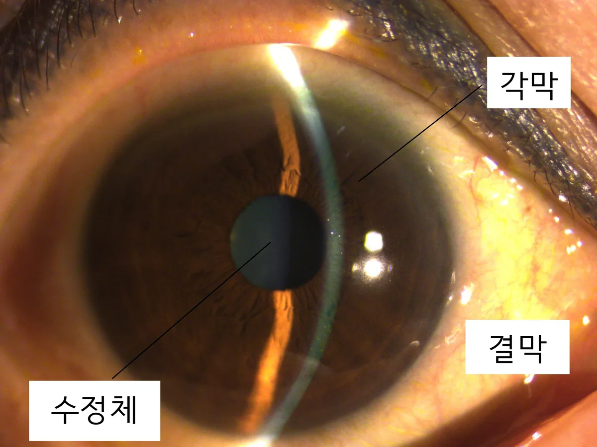 각막, 결막, 수정체의 위치를 표시한 전안부 구조 이미지