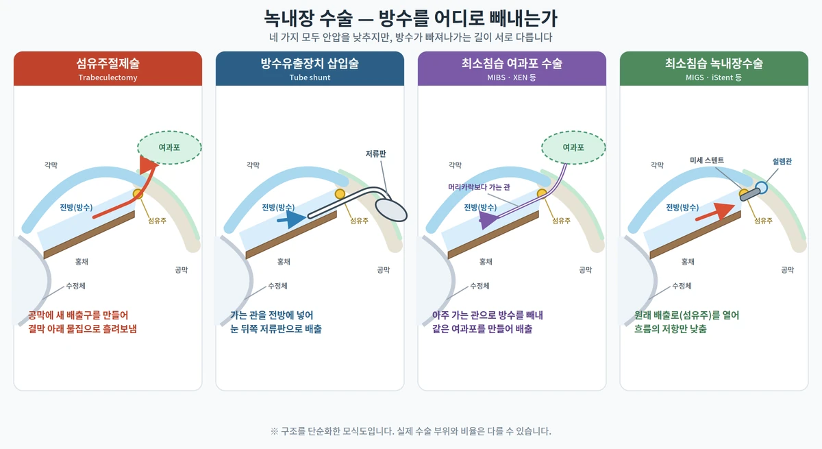 섬유주절제술, 방수유출장치 삽입술, 최소침습 여과포 수술(MIBS), 최소침습 녹내장수술(MIGS)에서 방수가 빠져나가는 경로를 나란히 비교한 모식도
