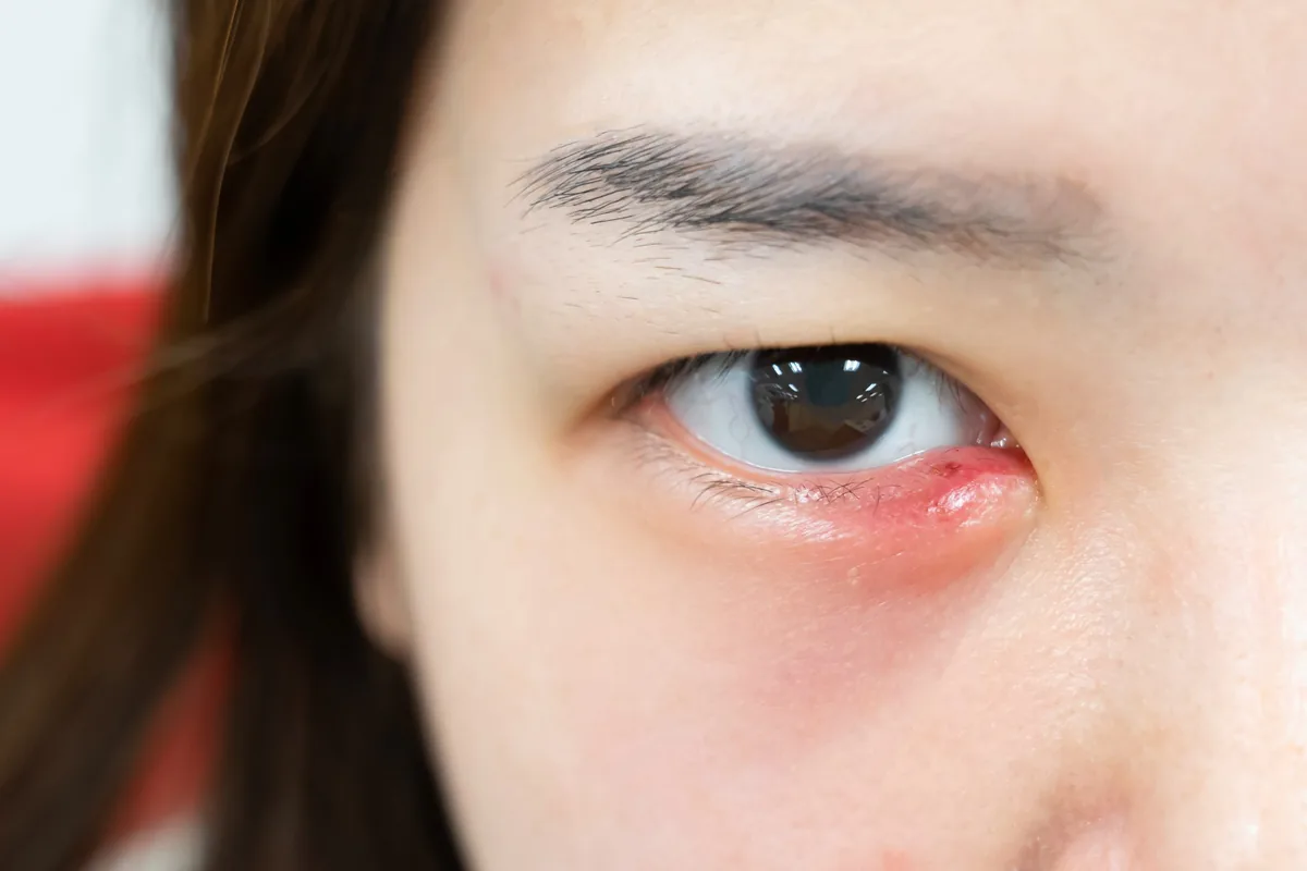 눈꺼풀 가장자리가 붉게 붓고 통증이 있는 다래끼