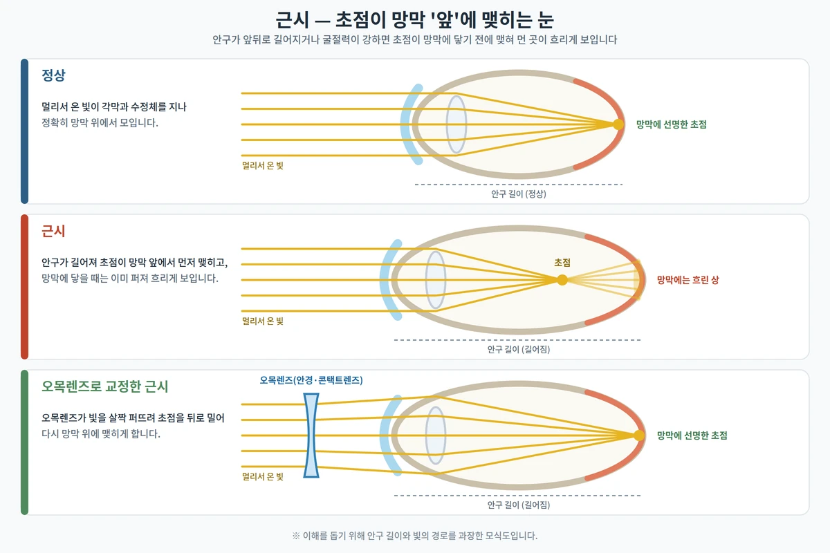 정상 눈, 근시 눈, 오목렌즈로 교정한 근시 눈에서 빛의 초점이 맺히는 위치를 비교한 도해 — 근시는 안구가 길어 초점이 망막 앞에 맺힘