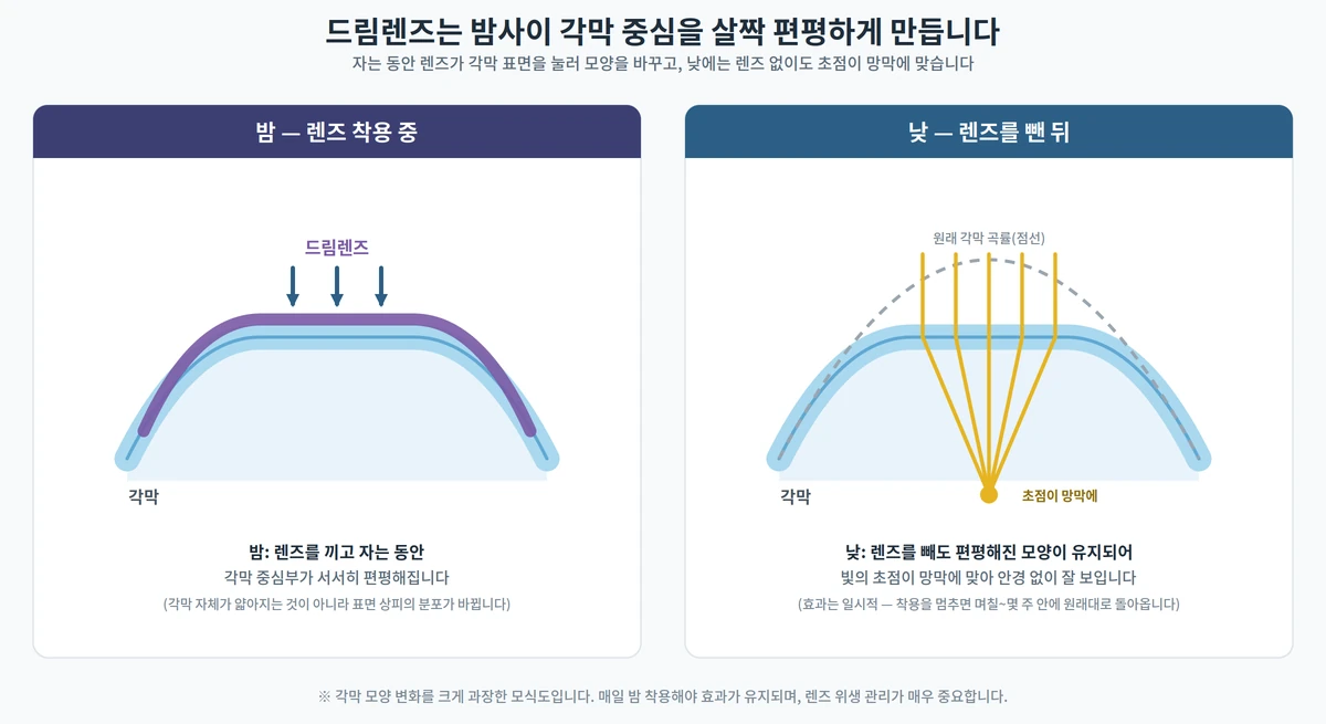 드림렌즈 원리 도해 — 밤에 렌즈가 각막 중심을 눌러 편평하게 만들고, 낮에는 렌즈 없이도 초점이 망막에 맺힘