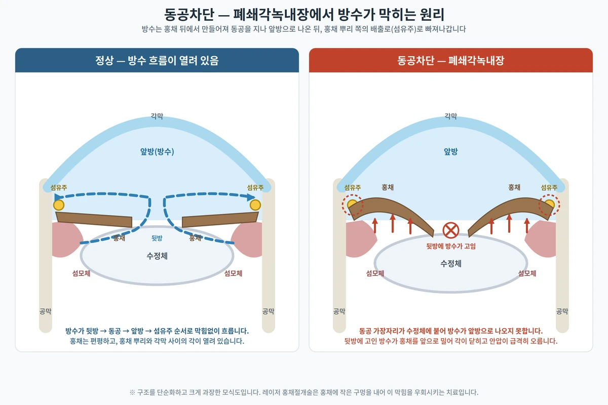 정상 눈과 동공차단이 일어난 눈의 앞쪽 단면 비교 도해 — 정상은 방수가 뒷방·동공·앞방·섬유주로 흐르고, 동공차단에서는 홍채가 수정체에 붙어 방수가 뒷방에 고이며 각이 닫힘