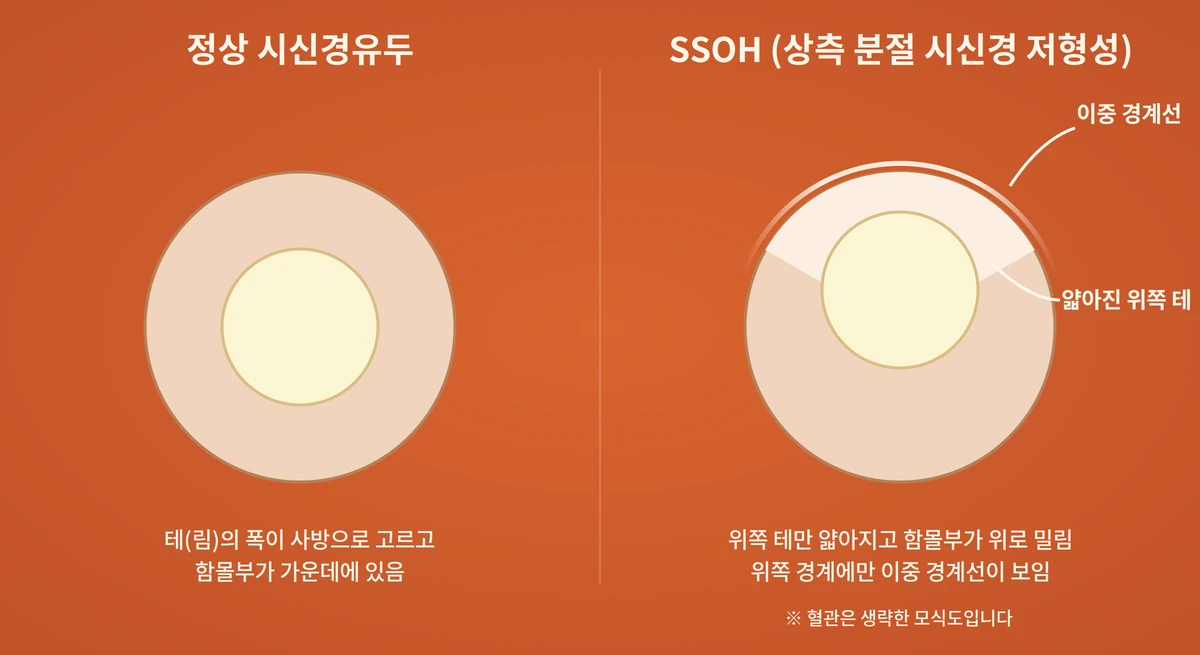 정상 시신경유두와 SSOH 시신경유두를 나란히 비교한 도해 — 오른쪽은 상측 테가 좁고 함몰부가 위로 밀려 있음