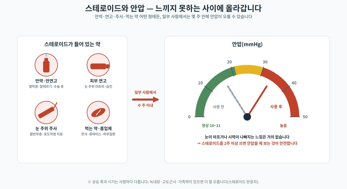스테로이드가 들어 있는 약(안약·연고·주사·먹는 약)과 사용 후 안압이 정상 범위를 넘어 오르는 안압계 도해